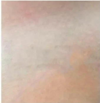 Antebrazo prácticamente limpio de tinta tras 5 sesiones de eliminación de tatuaje