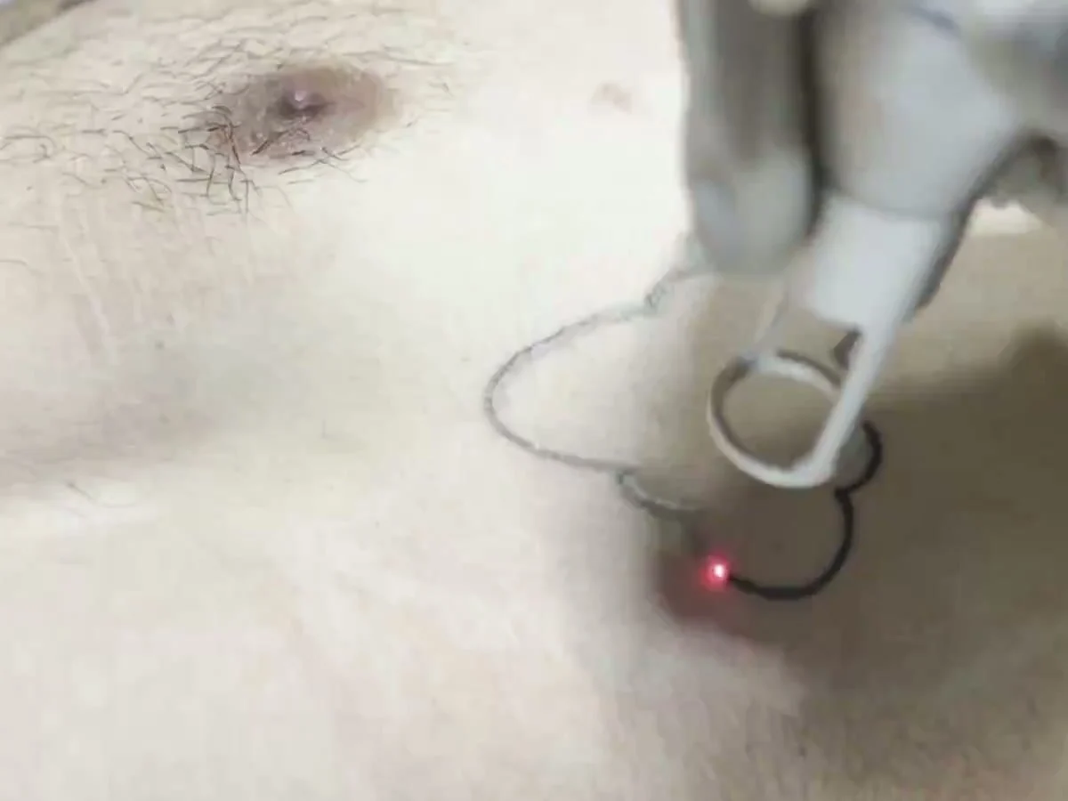 Aplicación del láser sobre un tatuaje en Clínica Elimint