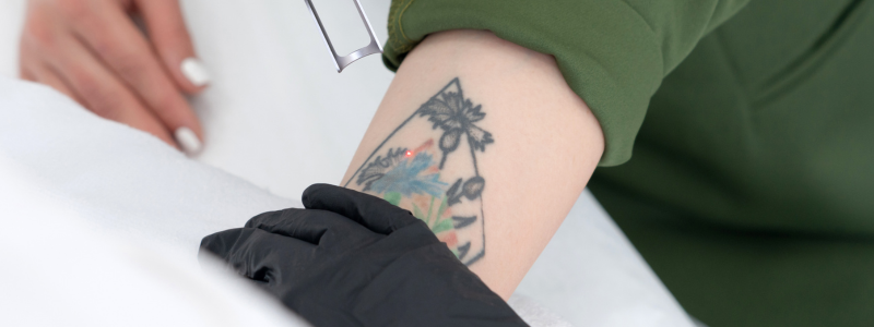 Borrar Tatuajes Valencia3