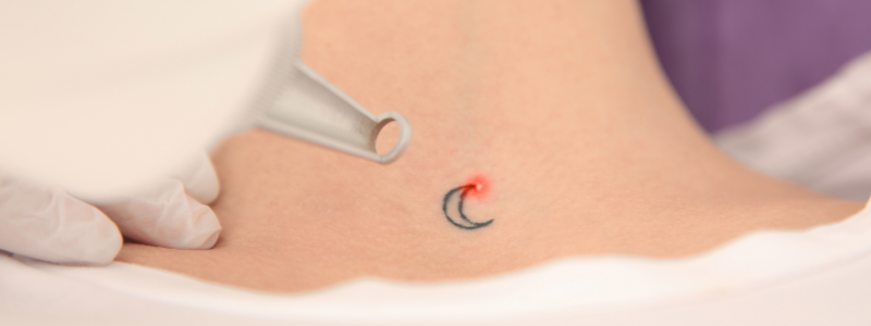 Eliminar tatuajes precio